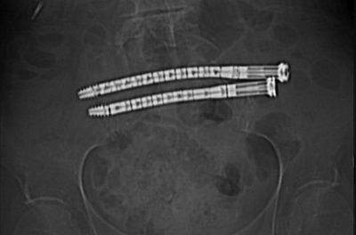 CurvaFix IM Implant (170 mm in length) placed in the upper sacral segment of the pelvis, followed by a transiliac-transsacral CurvaFix IM Implant (150 mm in length) in S2
